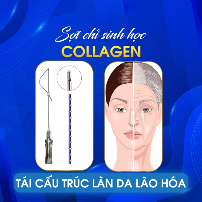 Cấy chỉ collagen căng da mặt có an toàn hay không?